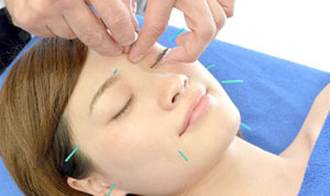 美容鍼(美容針)